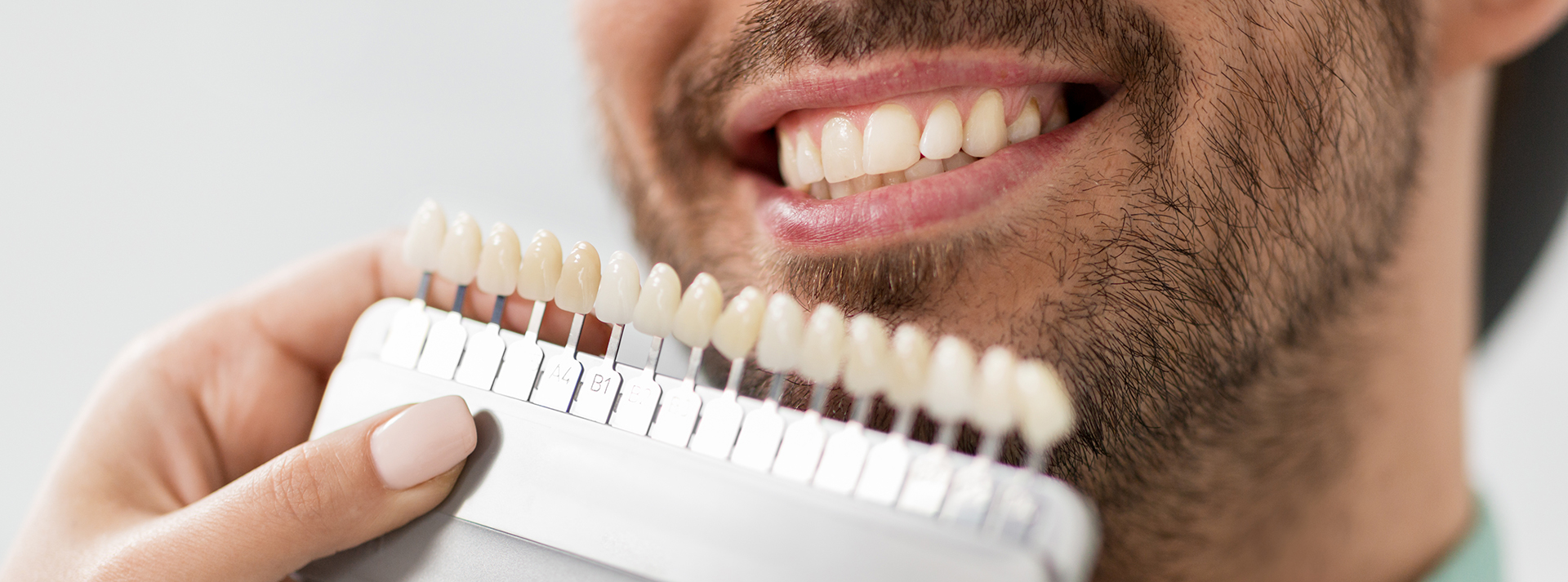 Things to Know About Dental Veneers