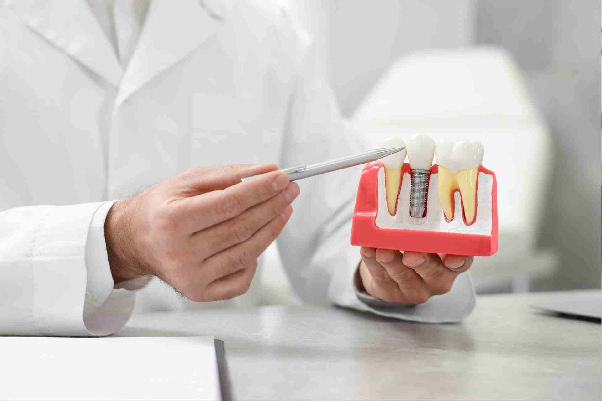 How Long Does a Dental Implant Procedure Really Take?