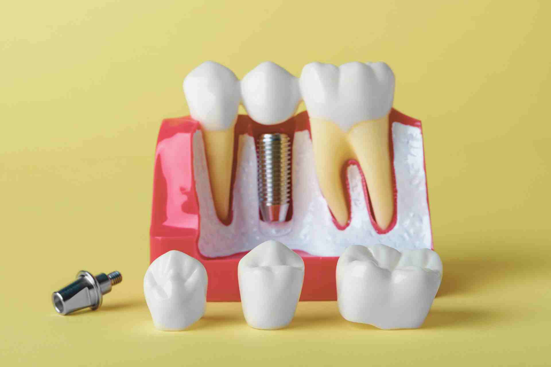 Dental Implant vs. Crown