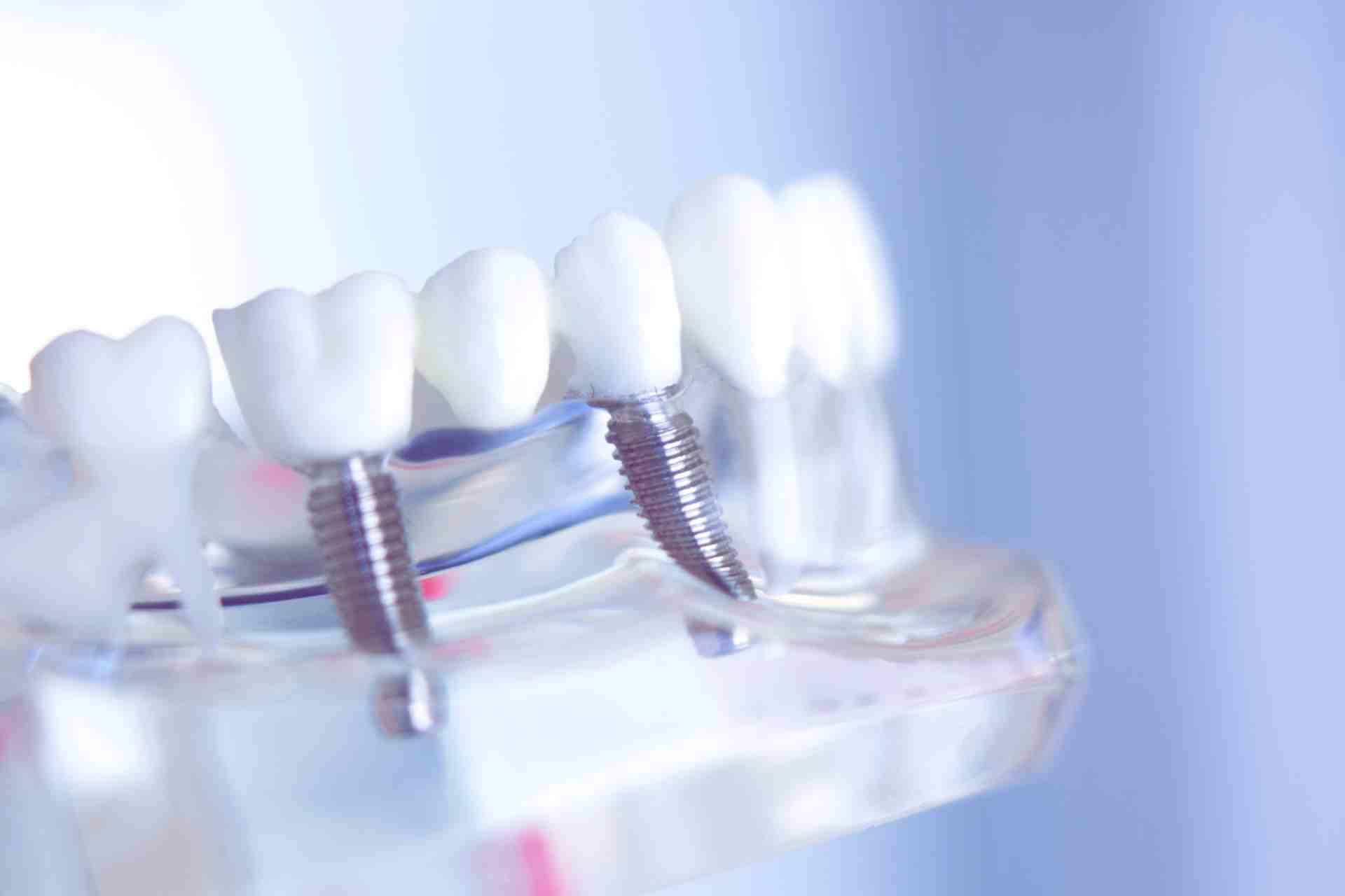 All-on-4 Dental Implants