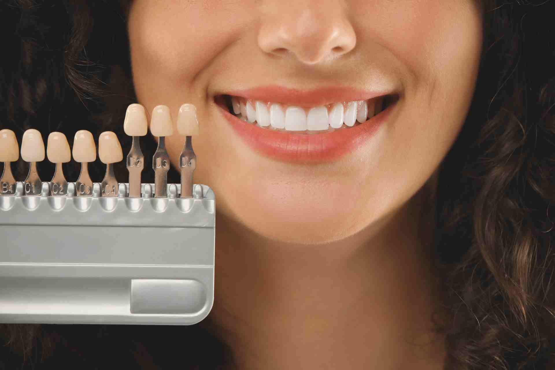 How Long Do Veneers Take to Heal?