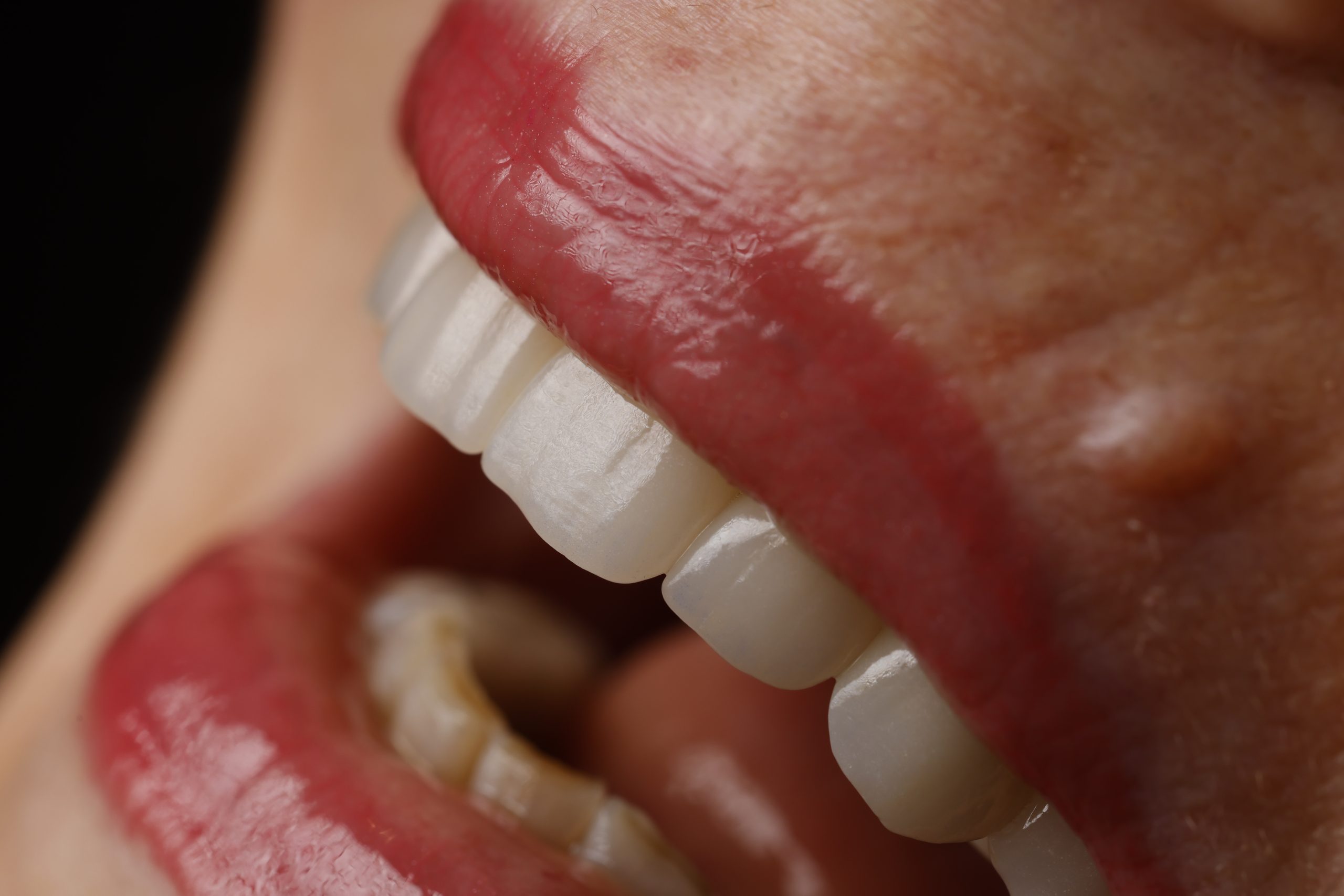 What is a Smile Makeover?