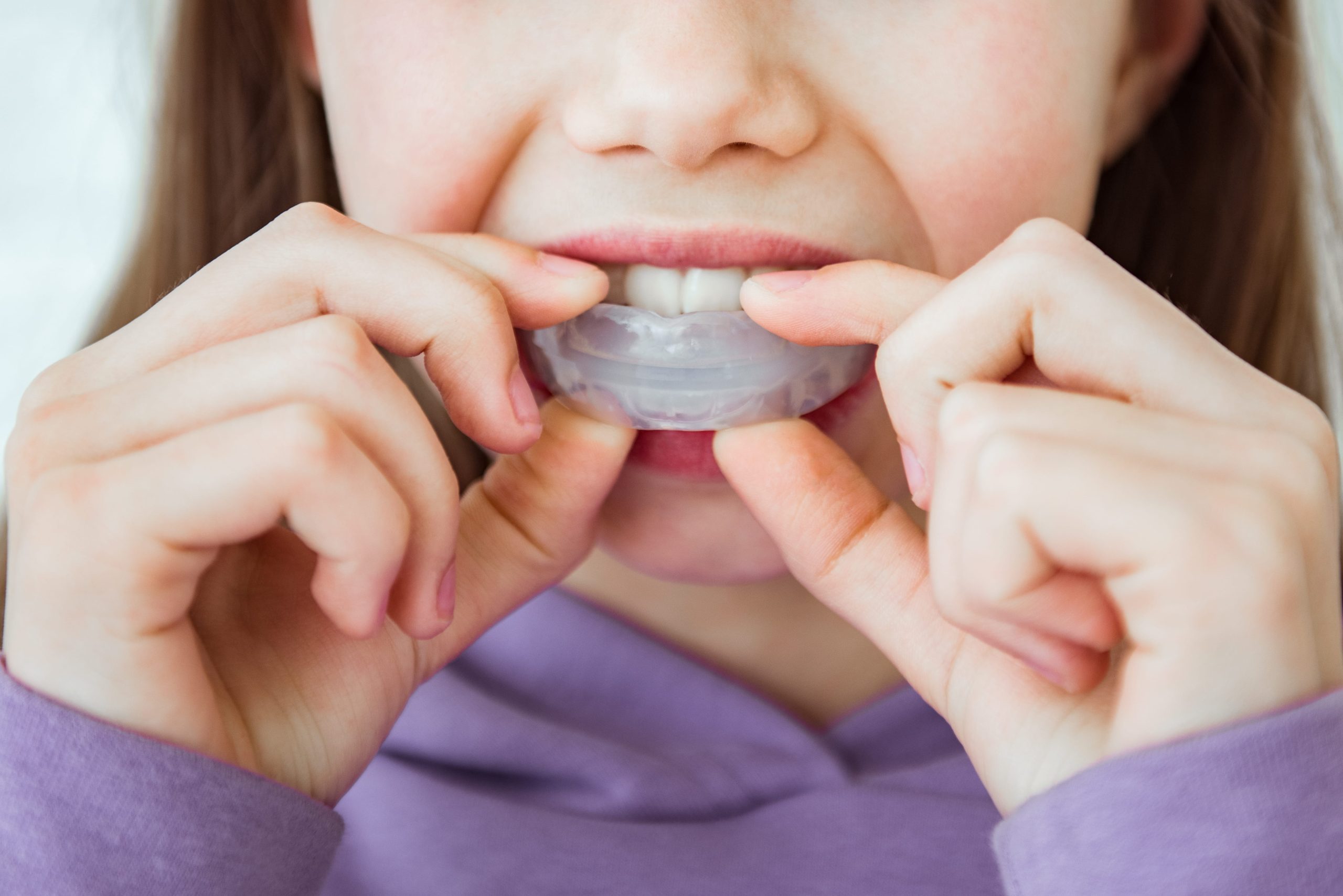 Sleep Apnea Mouth Guard