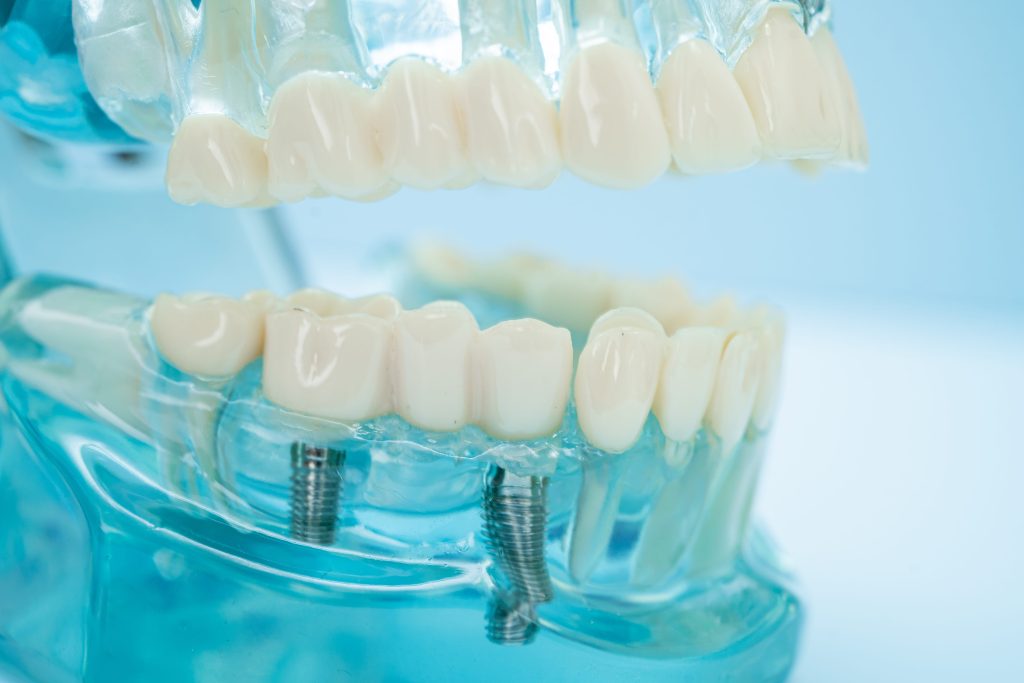 Dental Implant Model for Education and Training