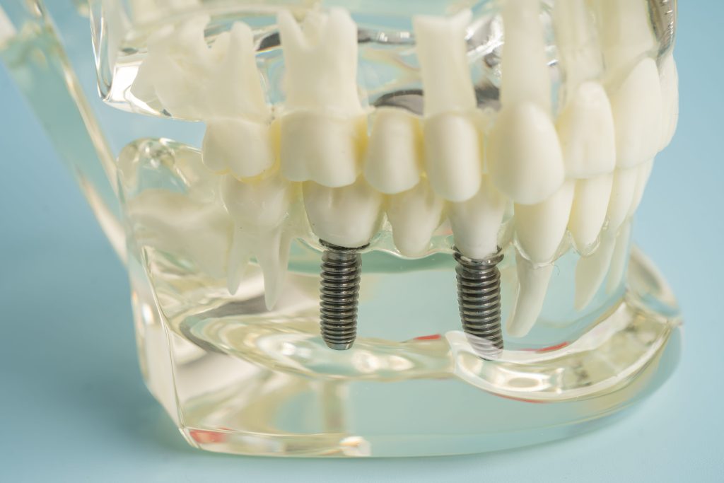 Dental Model Showing Titanium Implants and Crowns on a Blue Background
