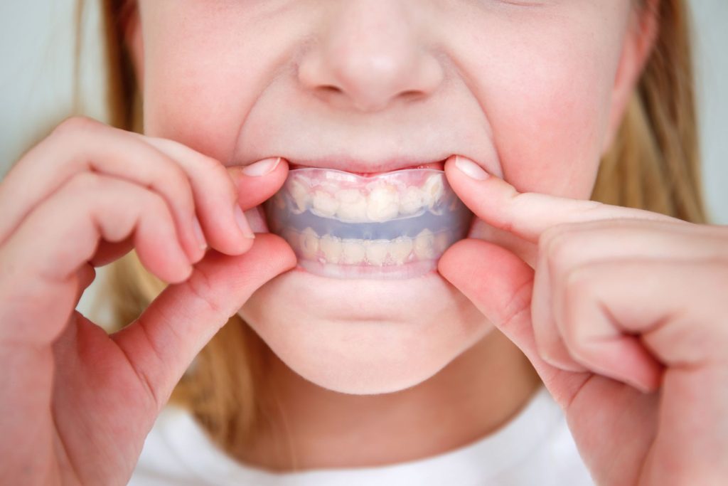 Child pulling back lips to show a clear orthodontic mouthguard fitted over upper and lower teeth